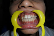 MNR Dental College - Dental Camp Photos